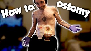 CHANGING MY OSTOMY BAG [upl. by Nivre]