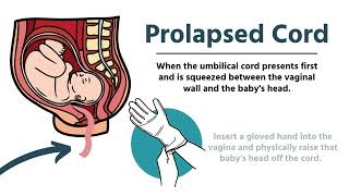 Pregnancy amp Delivery Emergencies in EMS [upl. by Porty615]