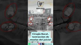 Cirugía Bucal dientes extraction clinicadental ecuador shorts youtubeshorts [upl. by Akiv]