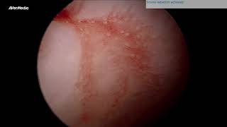 DIAGNOSTIC HYSTEROSCOPY IN VIEW OF IRREGULAR PERIODS BY DR SAHETYA AT PUSHPAA HOSPITAL [upl. by Born]