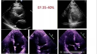 visual estimating LV Ejection Fraction [upl. by Gretna939]