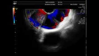 COMPLEX ovarian cyst SOLID COMPONENT ALONG WITH FOLLICLES hydropic [upl. by Keheley422]