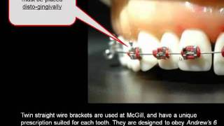 How important is the position of your orthodontic braces [upl. by Onairotciv14]