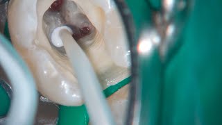 DRendo  Full pulp chamber pulpotomy in a mandibular second molar [upl. by Siraved263]