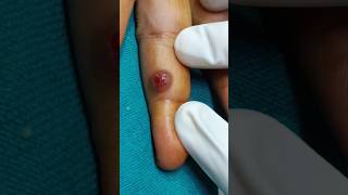 Pyogenic Granuloma treatment dermatologist skintreatment pyogenicGranuloma minivlog shortvideo [upl. by Bonnie]