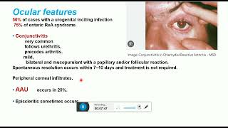 uveitis in spondyloarthropathies and JIA [upl. by Lunneta892]