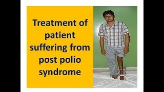 Treatment of patient suffering from post polio syndrome [upl. by Plate]