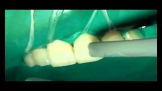 Doctor Smile Dental Laser  Erbium Yag removal of dentin [upl. by Wenger276]