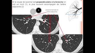 Lecture d’une radiographie thoracique Pathologique Sd Bronchique et interstitiel [upl. by Eppes]