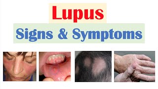 Lupus Signs amp Symptoms amp Why They Occur  Skin Joints Organ Systems [upl. by Burns]