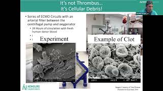 Hemolysis in Pediatric ECLS [upl. by Hart]