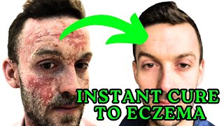 The Best amp Most Effective Remedy for Eczema [upl. by Asilram477]