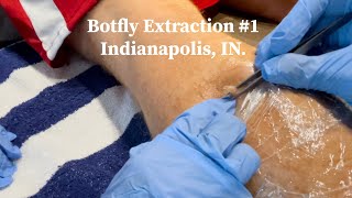 Botfly Extraction  55 day gestation  explosive extraction [upl. by Aiker406]