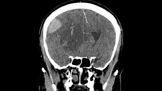 Brain herniation  subphalcine  due to intracranial haemorrhage CT findings [upl. by Eisseb475]