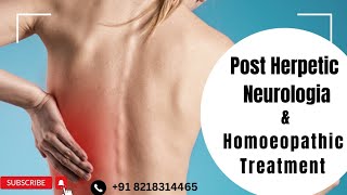 PHN  Post Herpetic Neurologia  Homoeopathic Treatment [upl. by Llerrac569]