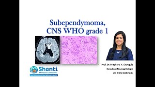 Subependymoma CNS WHO grade 1 [upl. by Alegnasor]