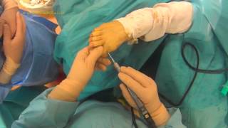 Hallux Valgus en chirurgie Mini Invasive Percutanée [upl. by Asi]