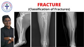 FRACTURE Classification  Lecture 02 I Orthopedics [upl. by Acirtal]