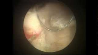 TURBT  TURP Cancer Prostate Surgery Video [upl. by Voleta]