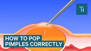 The Only Right Way To Pop Your Pimples [upl. by Constantino707]