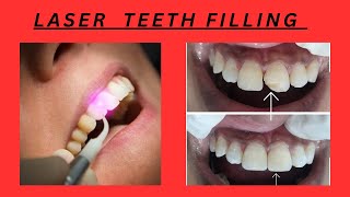 LASER FILLING MATERIAL  LASER TEETH FILLING  LASER VS BLUE LIGHT CURED COMPOSITE [upl. by Hennebery]