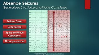 Absence Seizures EEG Findings [upl. by Boorman]