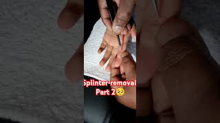 Splinter removal part 2 pain spiritualhealer [upl. by Sammer]