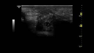 Ecografía de neuroma terminal traumático de mediano en muñeca [upl. by Claudetta]