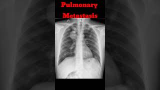 Chest Xray  Pulmonary Metastasis chestradiography chestxray shorts radiology [upl. by Ivette]