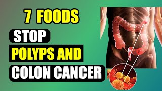 7 Superfoods to Get Rid of Colon Polyps and Prevent Bowel Cancer [upl. by Mendel]