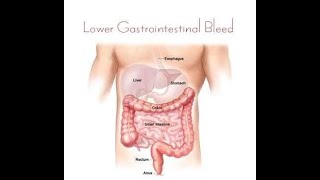 Physical Examination for A patient with Lower Gastrointestinal tract Bleeding [upl. by Nellek]