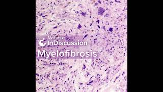 Whats Your Approach Treating Myelofibrosis [upl. by Jobye309]