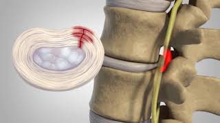 Herniated Disc  Patient Education [upl. by Novahc9]