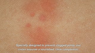 What the hell is this Acne Removal Cream [upl. by Perr559]