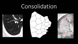 Chest Radiology  Patterns  Airspace [upl. by Trillby162]