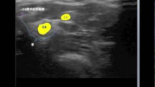 C5C6 cervical nerve root blocks [upl. by Fatsug]