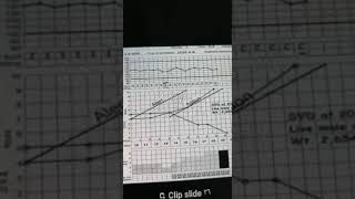 partogram Dr rania2 [upl. by Leima]