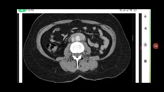 Idiopathic retroperitoneal fibrosis case radiologyintersting casebasicradiopediaradiologytips [upl. by Akehsay]