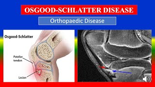 OSGOOD SCHLATTER DISEASE  Definition types causes pathophysiology signs amp symptoms medicine [upl. by Aisatsan471]