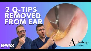 2 QTIPS REMOVED FROM EAR  EP958 [upl. by Yrtnahc639]