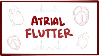 Atrial flutter  causes symptoms diagnosis treatment pathology [upl. by Cordell]