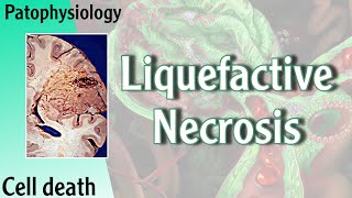 Pathophysiology  Liquefactive Necrosis Hani Laith شرح [upl. by Matusow]