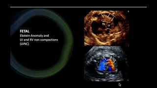 Fetal Ebstein noncompaction [upl. by Atikram]