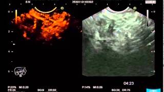 Detection and Characterization of Solid Pancreatic Lesions [upl. by Aryc]