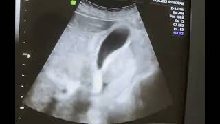 Non inflammatory Gallbladder wall edema Diagnostic ultrasound case [upl. by Aretse296]