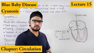 Cyanosis  Blue baby  Cardiovascular disorders  Chapter Circulation video 15 [upl. by Pebrook]