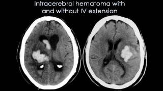 Radiology  Cerbrovascular accident Stroke [upl. by Mechelle]