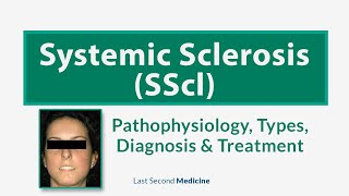 Systemic Sclerosis SScl  Scleroderma  Types Pathophysiology Diagnosis amp Treatment of SScl [upl. by Flem]