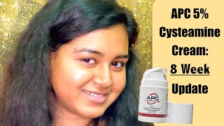 APC 5 Cysteamine Cyspera Dupe 8 Week Update on Melasma [upl. by Sumedocin]