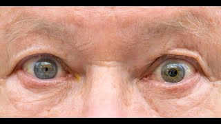 Anisocoria  Symptoms and Causes  Diagnosis  Treatment  Prevention [upl. by Sefton597]